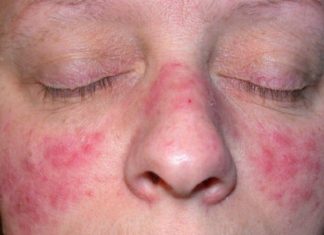 El ABC de la rosácea: Todo lo que querías saber