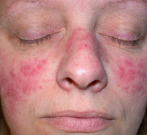 El ABC de la rosácea: Todo lo que querías saber