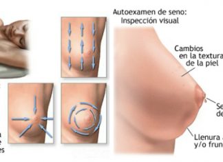 Cáncer de mama: Pasos para un autoexamen de mama Cómo detectar un cáncer de mama