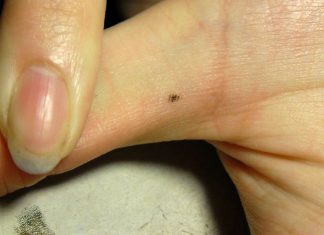 La gran mayoría de lunares en el pie o mano son benignos