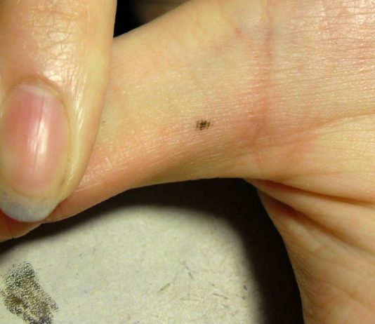 La gran mayoría de lunares en el pie o mano son benignos
