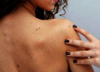 Personas con más cantidad de lunares tienden a vivir más años